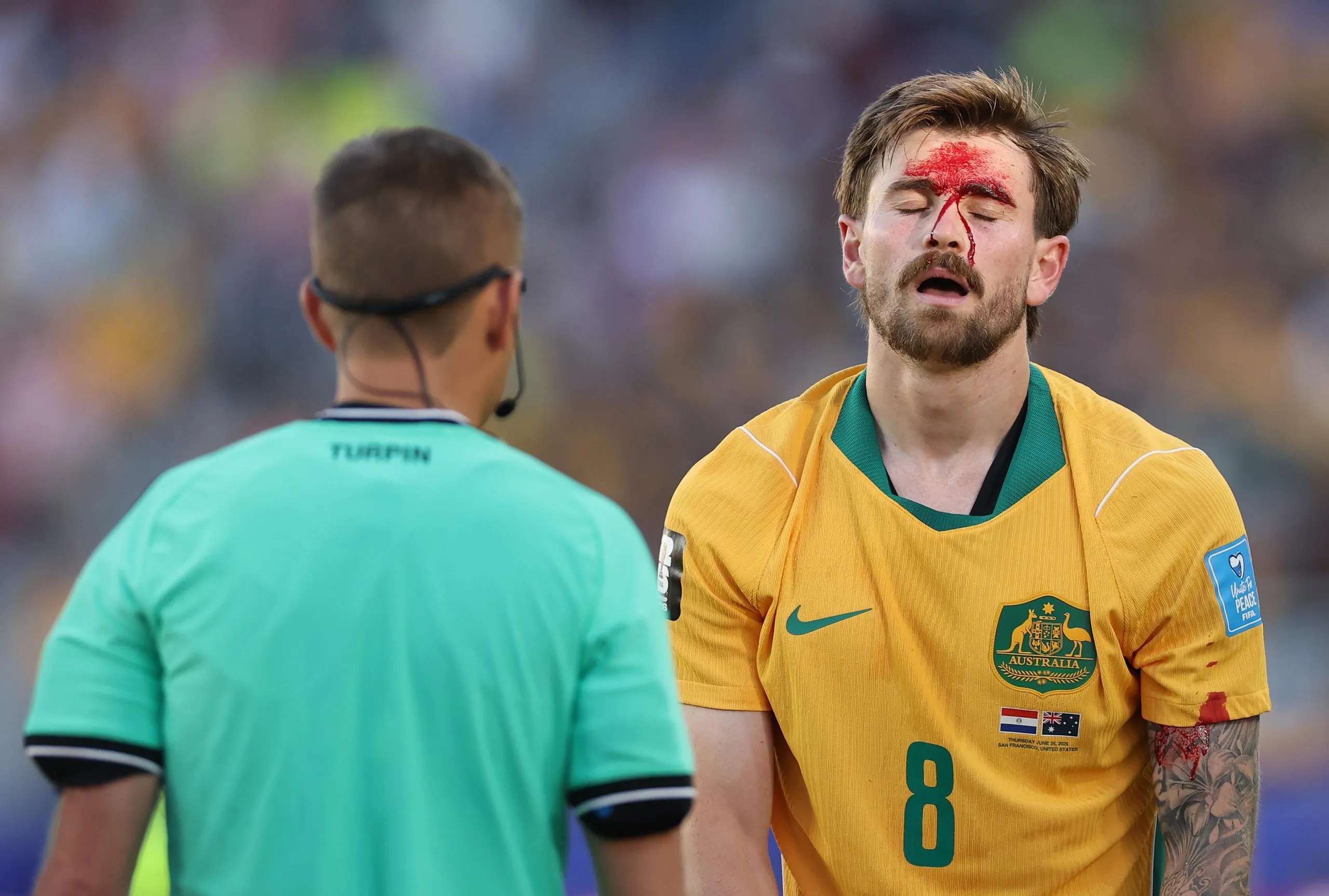 Connor Metcalfe of Australia shows the referee his bloodied forehead against Paraguay at San Francisco Bay Area Stadium.
